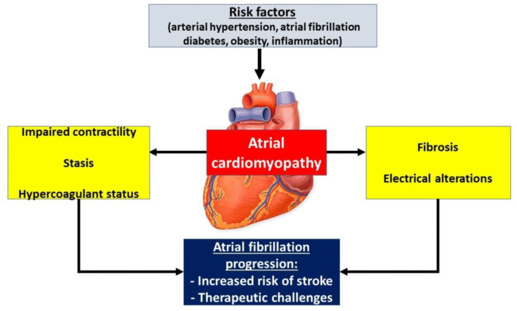 Atrial Cardiomyopathy Raises Stroke and Heart Risk