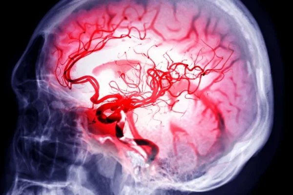 GLP-1RAs Linked to Reduced Haemorrhagic Stroke Risk